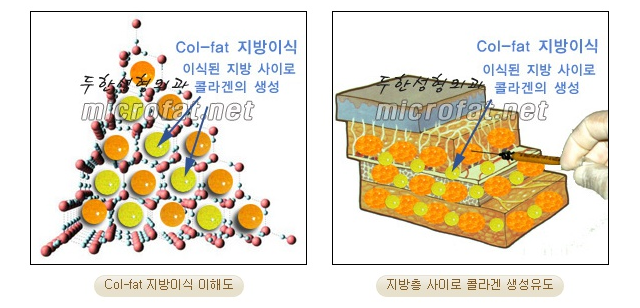 [두한성형외과 콜펫 지방이식] - [터널링기법, 미세지방이식, 다층지방이식] 관련 이미지 3