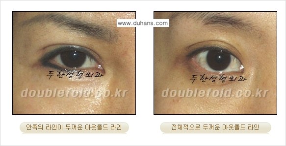 [두한성형외과] - [아웃폴드를 인폴드로 변화시키는 쌍꺼풀재수술] 관련 이미지 2