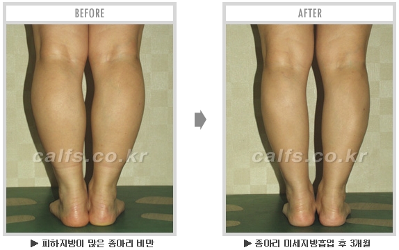 [종아리성형 두한성형외과] - [종아리수술에 대한 자주하는 질문과 답변 모음] 관련 이미지 79