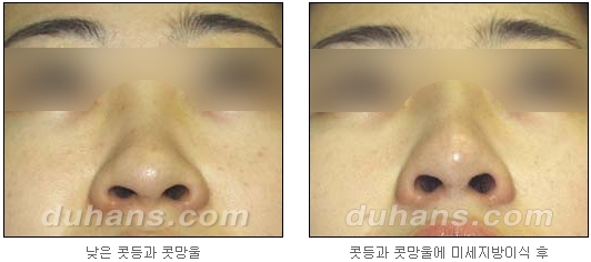 [두한성형외과 얼굴자가지방이식] - [코지방이식] 관련 이미지 9