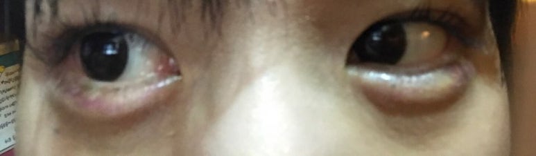 Duhan Plastic Surgery Under-Eye Surgery - Correction with Fat Grafting After Aegyo-Sal Filler image 6