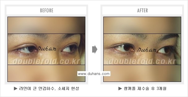 [두한성형외과 쌍꺼풀 재수술] - [눈매교정이 과한 경우의 문제] 관련 이미지 5