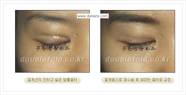 [두한성형외과 경쟁력 쌍꺼풀(눈) 재수술] - [쌍꺼풀 재수술시 잘못된 수술로 인한 넓어진 흉터 처리 안내] 관련 이미지 2
