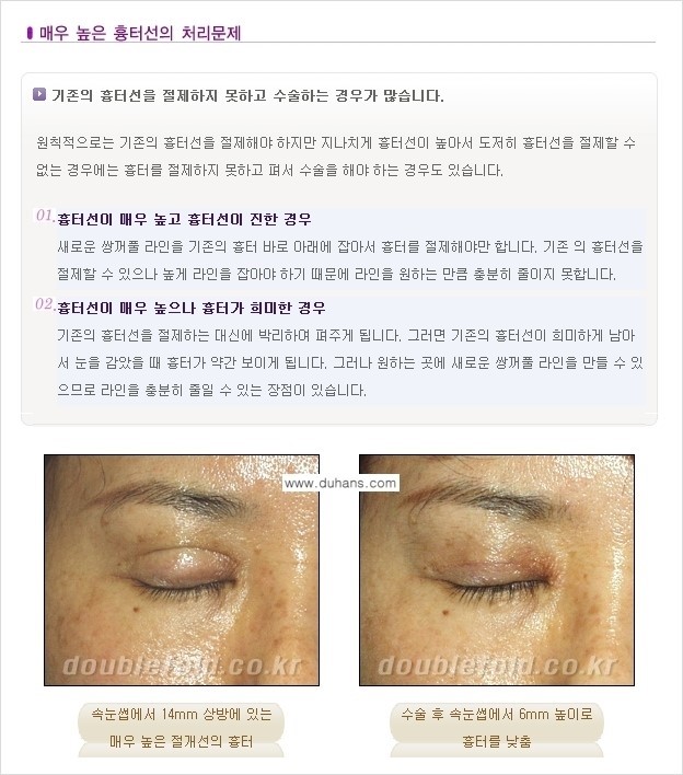 [두한성형외과 쌍꺼풀 재수술] - [쌍꺼풀 재수술에서 극복해야 할 극한의 상황과 문제들] 관련 이미지 11