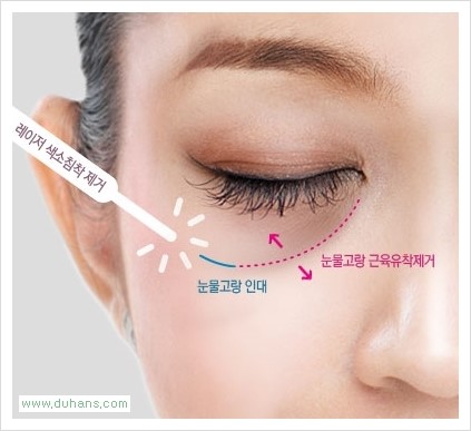 [두한성형외과 Dr. 컬럼] - [눈밑 다크써클 치료의 효과] 관련 이미지 6