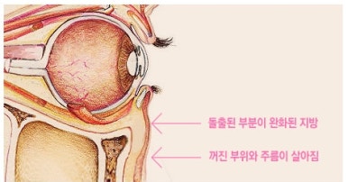 [Duhan Plastic Surgery Dark Circles] - [Under-Eye Fat Repositioning] image 4