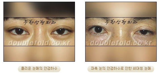 과교정 눈매 (소세지 쌍커풀 재수술, 눈매교정 재수술) 관련 이미지 2