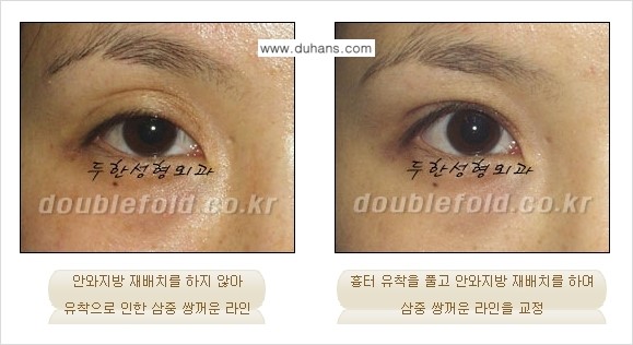 ​[두한성형외과] - [쌍꺼풀 재수술 클리닉의 특성과 자부심] 관련 이미지 8