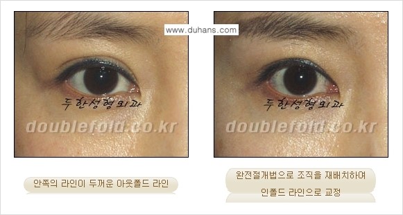 [두한성형외과 경쟁력 쌍꺼풀 재수술, 극한 눈재수술] - [심한 아웃폴드 라인을 인폴드 라인으로 교정 방법 안내] 관련 이미지 9