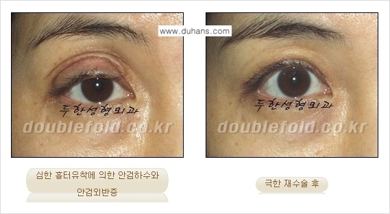 [두한성형외과 경쟁력 쌍꺼풀 재수술] - [망가진 쌍꺼풀 라인을 교정하는 극한재수술 ①] 관련 이미지 11