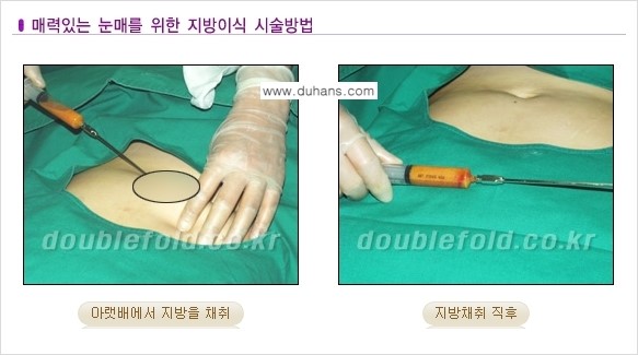 [두한성형외과 NO.1 눈성형] - [함몰된(꺼진) 눈꺼풀에서 쌍꺼풀 라인 교정 2.] 관련 이미지 1