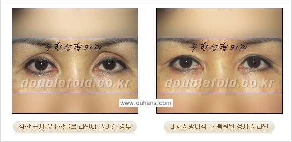 [두한성형외과 NO.1 눈성형] - [함몰된(꺼진) 눈꺼풀에서 쌍꺼풀 라인 교정 3.] 관련 이미지 9