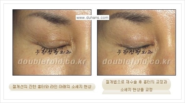[두한성형외과 경쟁력 쌍꺼풀 재수술, 극한 재수술] - [망가진 눈 복원수술 - 흉터선이 진한 경우 교정 안내] 관련 이미지 2
