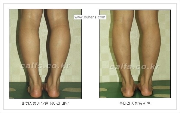 [두한성형외과 경쟁력 멀티종아리성형] - [예쁜 종아리를 만드는 종아리 지방흡입술 안내] 관련 이미지 11