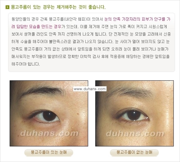 [두한성형외과 경쟁력 눈성형] - [매력적이고 아름다운 쌍꺼풀이란?] 관련 이미지 6