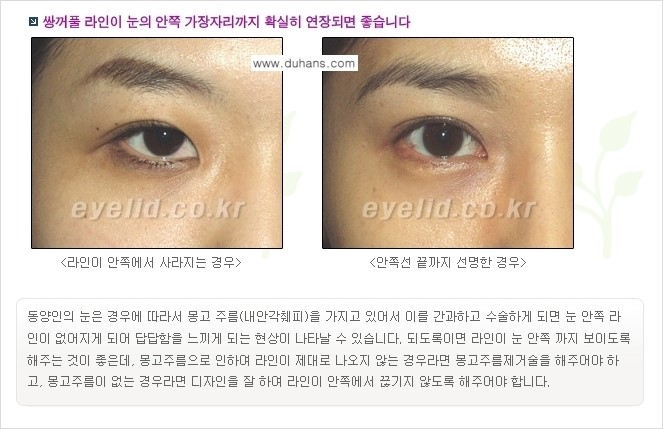 [두한성형외과 경쟁력 눈성형] - [퀵쌍꺼풀(부분절개법) 수술 안내] 관련 이미지 2