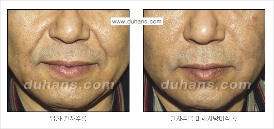 [두한성형외과 경쟁력 주름성형] - [미세지방이식을 이용한 주름교정 안내 - 눈밑주름, 입가주름, 팔자주름 2.] 관련 이미지 18