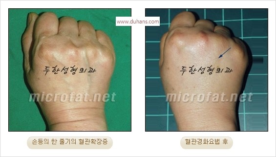 [두한성형외과 경쟁력 정맥류] - [손, 팔의 정맥확장증(혈관확장증) 치료 방법 안내] 관련 이미지 12