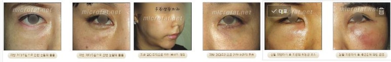 [Duhan Plastic Surgery Face Fat Grafting] - [Reducing Mouth Corners Wrinkles and Nasolabial Folds] image 25
