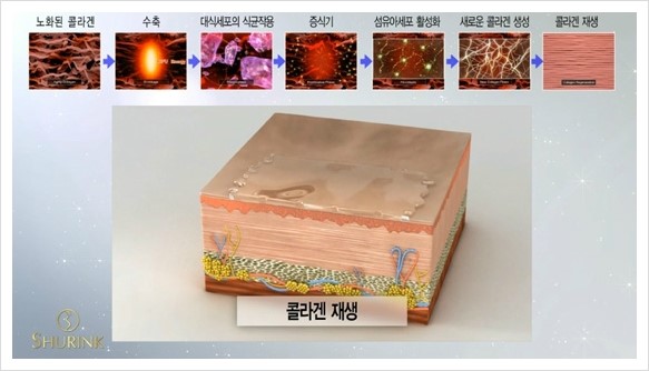 [두한성형외과 경쟁력 주름성형] - [주름제거를 위한 리프팅] 관련 이미지 40