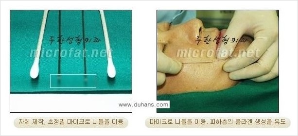 [두한성형외과 경쟁력 지방이식] - [두한 자가지방이식 클리닉 안내]​ 관련 이미지 31