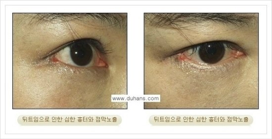 ​[두한성형외과 경쟁력 눈매성형] - [눈의 가로길이를 키우는 앞트임, 뒤트임 수술] 관련 이미지 21