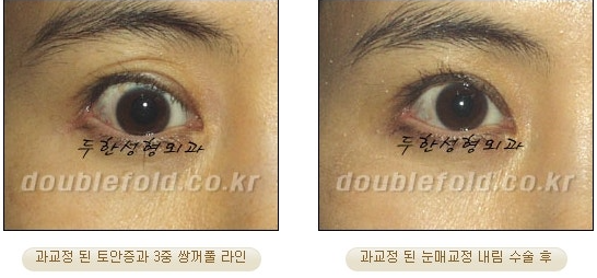 과교정 눈매 (소세지 쌍커풀 재수술, 눈매교정 재수술) 관련 이미지 1