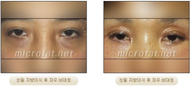 [두한성형외과 지방이식] - [타병원의 지방이식 부작용 교정] 관련 이미지 5