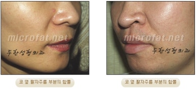 [Duhan Plastic Surgery Face Autologous Fat Grafting] - [Noble Surgery and Indian Band Fat Grafting] image 6