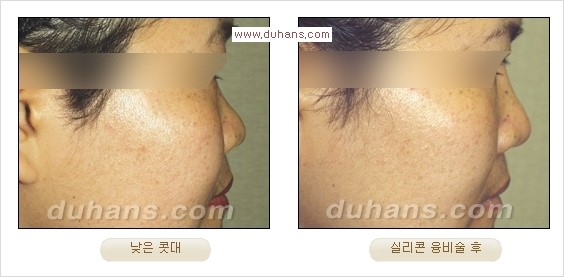 [두한성형외과 경쟁력 코성형] - [코성형을 위한 알로덤(슈어덤) 수술, 실리콘 수술 안내] 관련 이미지 32