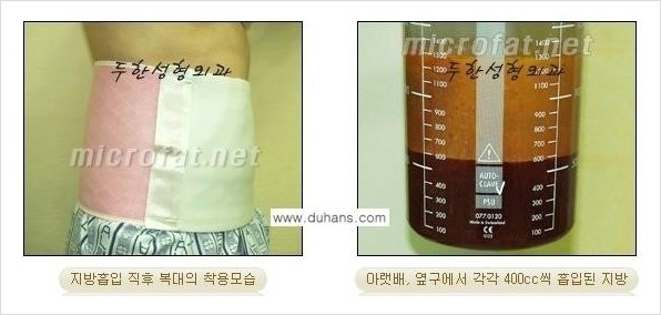 [두한성형외과 경쟁력 바디성형] - [하복부, 팔뚝, 허리선, 허벅지, 엉덩이 간편지방흡입술] 관련 이미지 10