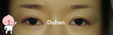 [Duhan Plastic Surgery Secondary Double Eyelid Surgery] - [Sleepy Eye Appearance, Asymmetrical Eye Appearance, Ptosis] image 3