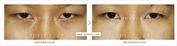 [두한성형외과 FOCUS 눈밑성형] - [다크써클의 치료방법 -  콜펫(Col-fat) 눈밑 미세지방이식 ①] 관련 이미지 6