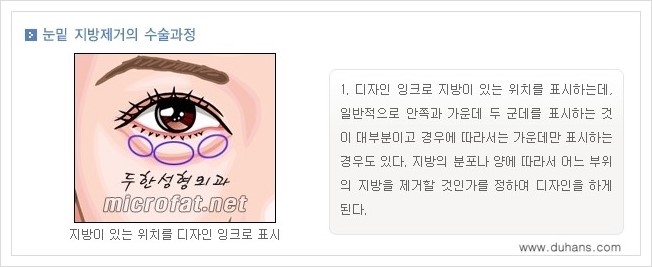 [두한성형외과 경쟁력 눈밑성형] - [눈밑지방제거, 눈위지방제거 안내 1.] 관련 이미지 5