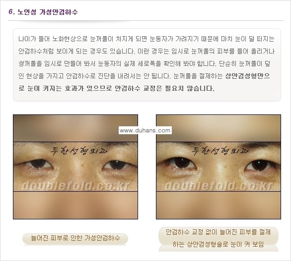 [두한성형외과 경쟁력 눈성형] - [안검하수(졸린 눈매) 재수술 안내 ①] 관련 이미지 9