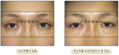 [Doohan Plastic Surgery Autologous Fat Grafting] - [Sunken Eye Fat Grafting] image 17