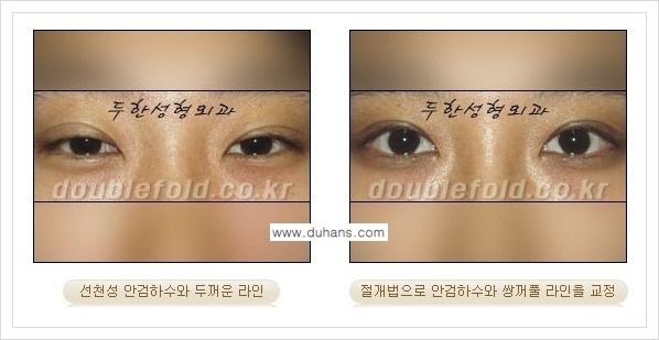 [두한성형외과 경쟁력 쌍꺼풀 재수술, 극한 재수술] - [안검하수(졸린눈매) 교정 방법 안내] 관련 이미지 2
