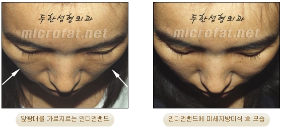 [Duhan Plastic Surgery Face Autologous Fat Grafting] - [Noble Surgery and Indian Band Fat Grafting] image 23