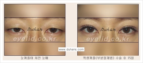 [두한성형외과 FOCUS 눈성형] - [퀵쌍꺼풀에 대한 질문과 답변들] 관련 이미지 3