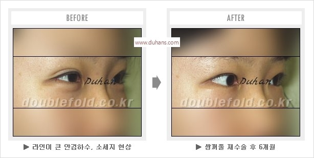 [두한성형외과 경쟁력 눈성형] - [나에게 맞는 어울리는 쌍꺼풀 라인] 관련 이미지 21