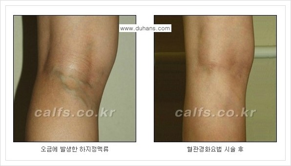 [두한성형외과 경쟁력 멀티종아리성형] - [나에게 맞는 종아리 시술 방법과 종류 안내 ③] 관련 이미지 16