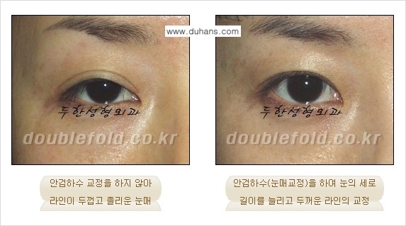 ​[두한성형외과] - [쌍꺼풀 재수술 클리닉의 특성과 자부심] 관련 이미지 6