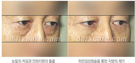 [두한성형외과 눈밑성형] - [무흉터 눈밑지방제거] 관련 이미지 8