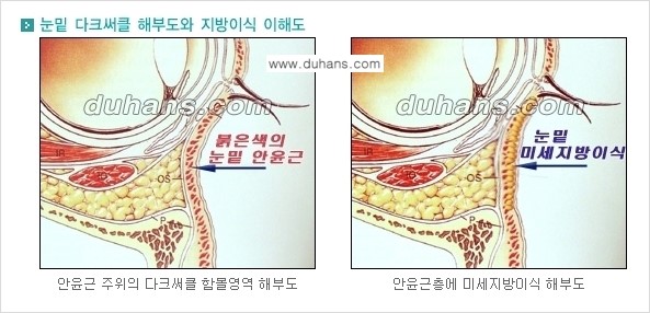 [두한성형외과 경쟁력 미세지방이식] - [다크써클 & 눈밑주름 미세지방이식 2.] 관련 이미지 7