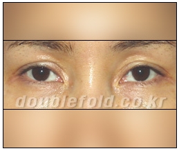 [Eye Reoperation Duhan Plastic Surgery] - [Guide to Double Eyelid Revision Surgery] image 11