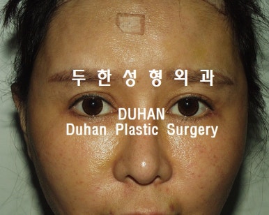 [Duhan Plastic Surgery Double Eyelid Revision] - [Reducing the Double Eyelid Line] image 22