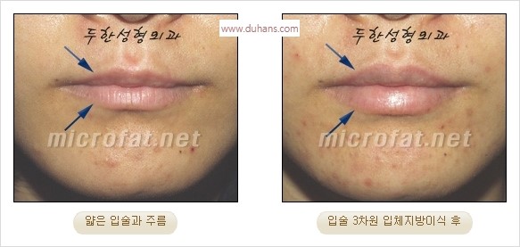 ​​[두한성형외과 경쟁력 미세지방이식] - [볼륨감 있는 입술성형] 관련 이미지 22