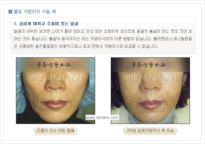 ⁠⁠[두한성형외과 경쟁력 볼살지방이식] - [심하게 야윈 주름이 있는 얼굴, 역삼각형 협소한 얼굴, 광대뼈가 돌출되어 보이는 경우 안내] 관련 이미지 9
