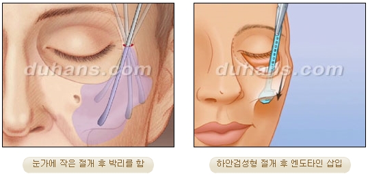 두한성형외과 안티에이징 리프팅 - 엔도타인 리프팅 관련 이미지 39