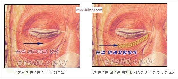 [두한성형외과 경쟁력 눈밑성형] - [눈밑 다크써클 수술 방법] 관련 이미지 12